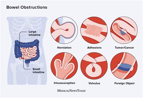 Bowel Obstruction after WLS: Causes, Symptoms and Treatments